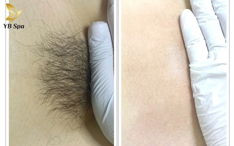 Với phong cách Hollywood, sự tiện lợi lâu dài từ công nghệ laser mang lại vẻ quyến rũ mịn màng và không tì vết