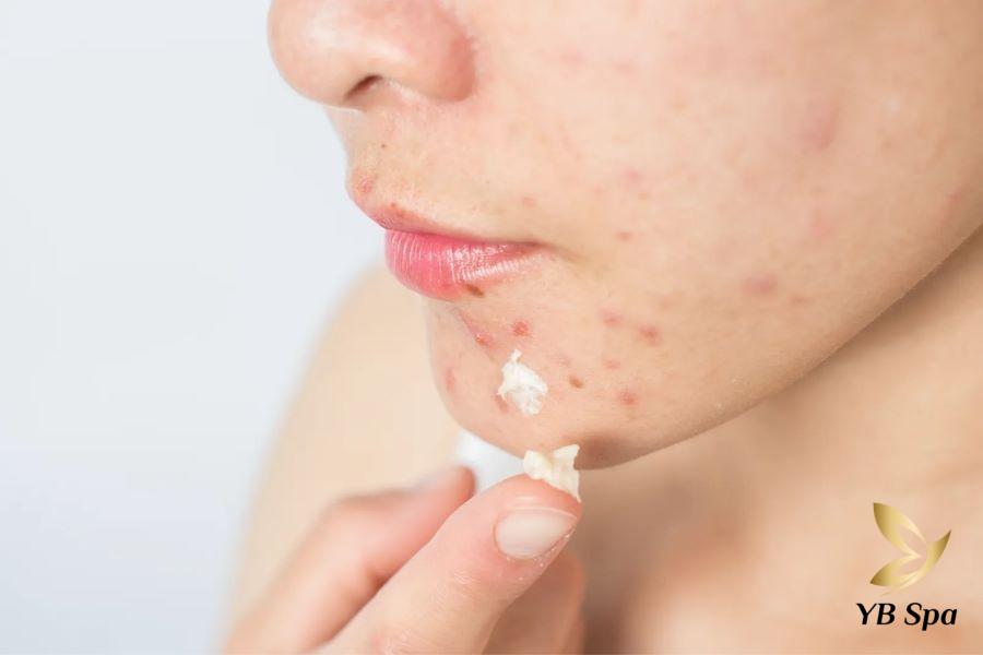 Tác dụng phụ của lưu huỳnh