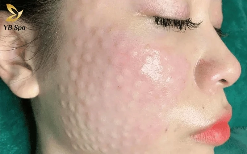 Các nốt sần nhỏ tại điểm tiêm chính là tinh chất đang được lưu giữ để thẩm thấu sâu, chúng sẽ tan dần và mịn màng sau 1 - 3 ngày