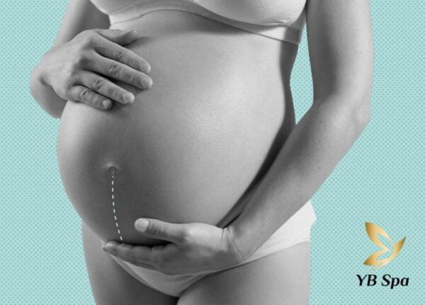 mang thai có được triệt lông bikini không