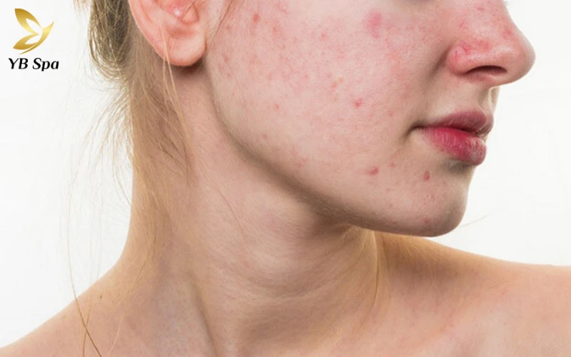 Mặt Nổi Mẩn Đỏ Như Mụn: Nguyên Nhân Và Cách Điều Trị Hiệu Quả 22 mặt nổi mẩn đỏ như mụn