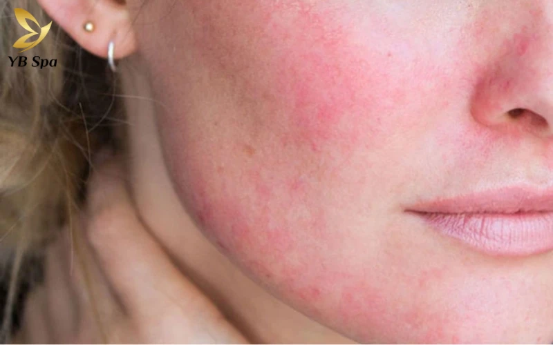 Mặt Nổi Mẩn Đỏ Như Mụn: Nguyên Nhân Và Cách Điều Trị Hiệu Quả 23 Thay đổi thời tiết gây mặt nổi mẩn đỏ như mụn