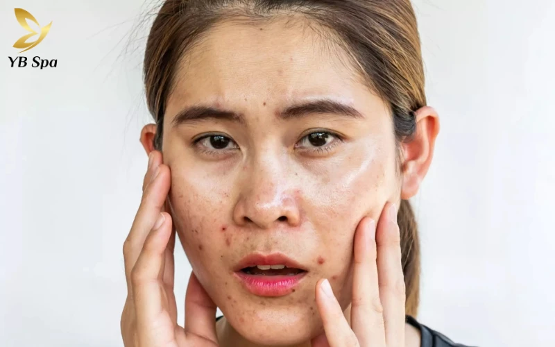 Mặt Nổi Mẩn Đỏ Như Mụn: Nguyên Nhân Và Cách Điều Trị Hiệu Quả 24 Da dầu dễ gây mụn