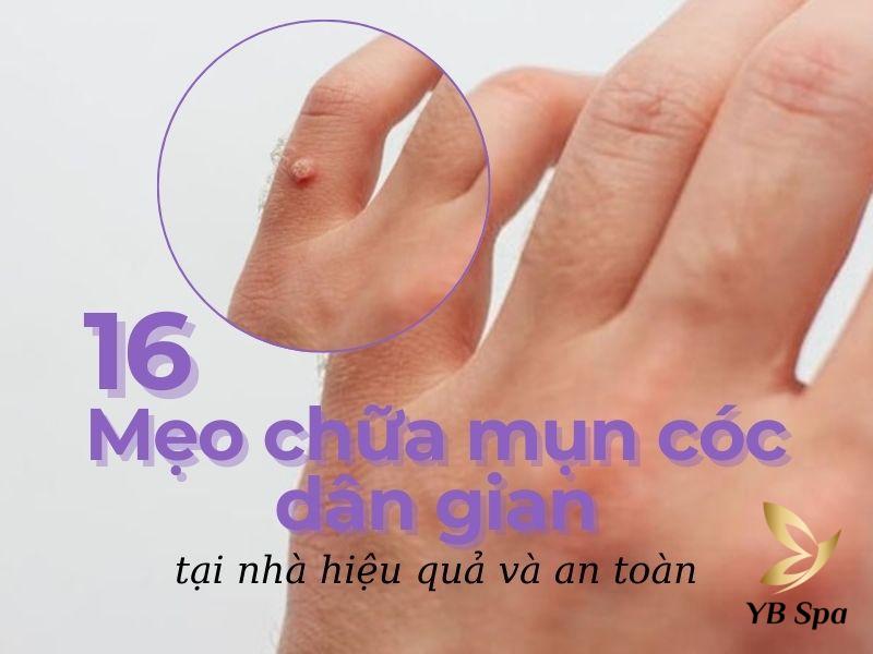 16 mẹo chữa mụn cóc dân gian tại nhà hiệu quả và an toàn