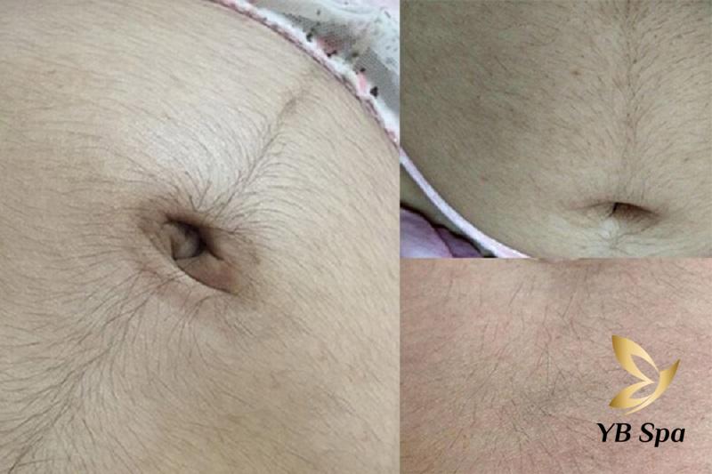 Mẹo Triệt Lông An Toàn Cho Bà Bầu Tự Nhiên Tại Nhà 21 Mẹo triệt lông an toàn cho bà bầu (Nguồn: Internet)