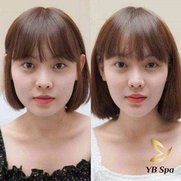 Kết quả của meso botox đem đến rất tự nhiên (Nguồn: Internet)