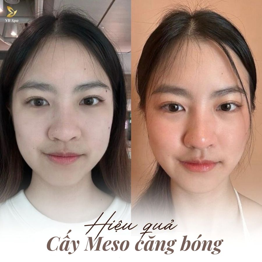 MESO CĂNG BÓNG 21 MESO CĂNG BÓNG