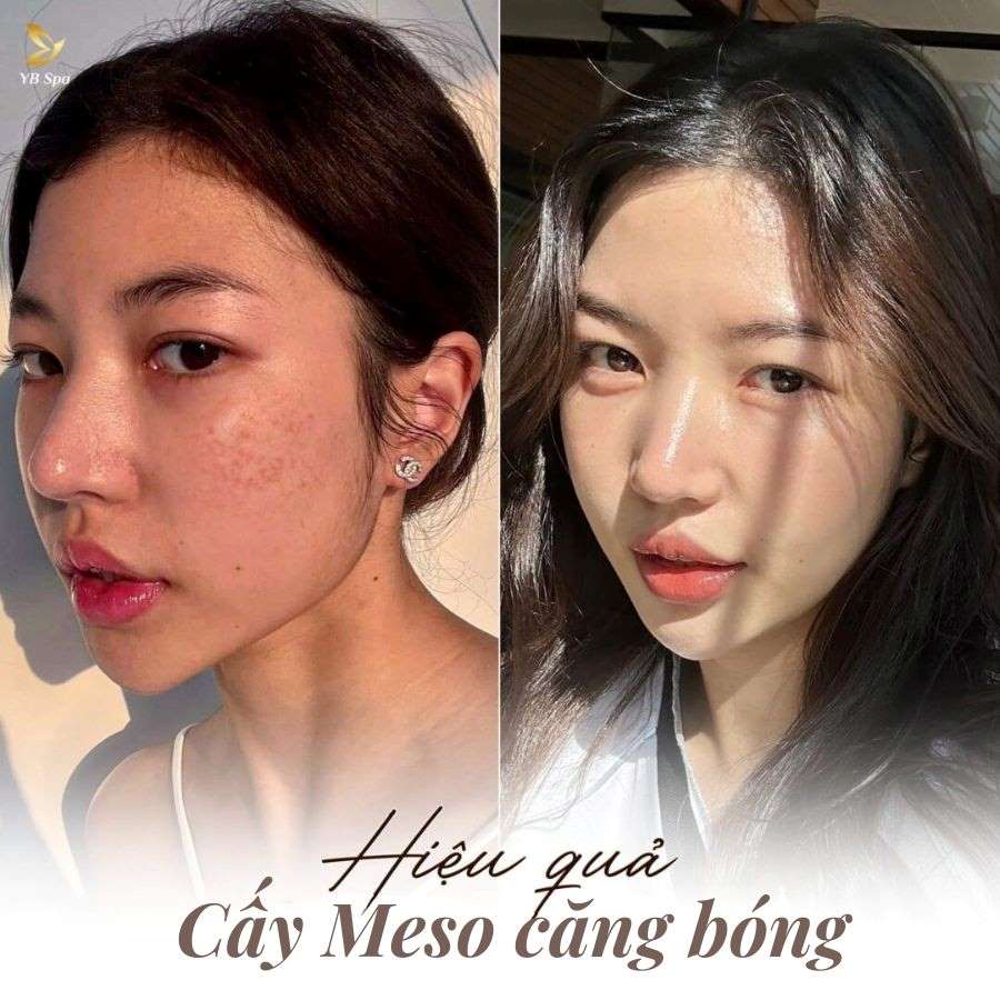 MESO CĂNG BÓNG 23 MESO CĂNG BÓNG