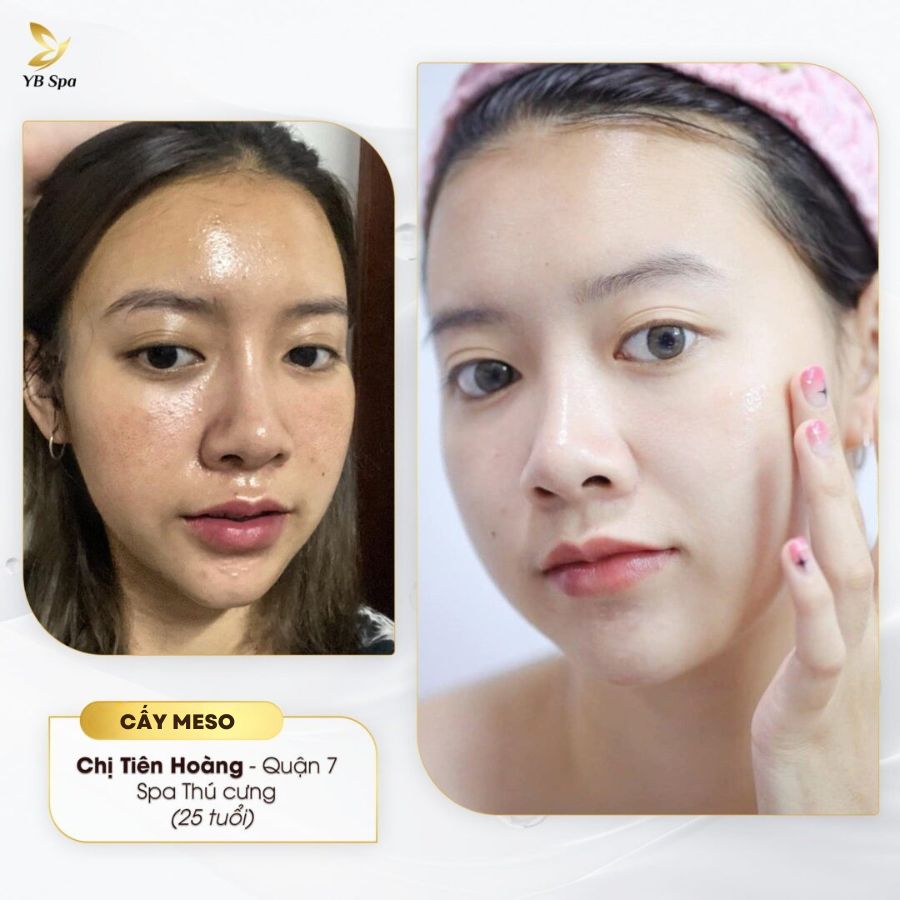 MESO CĂNG BÓNG 24 MESO CĂNG BÓNG