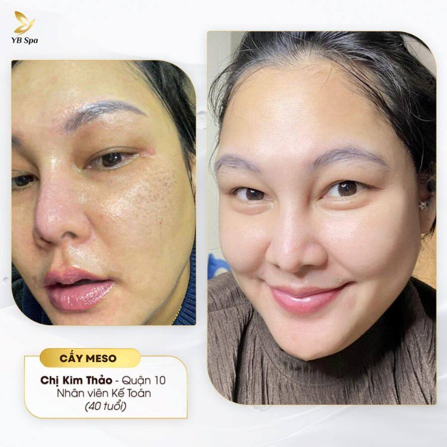 MESO CĂNG BÓNG 26 MESO CĂNG BÓNG