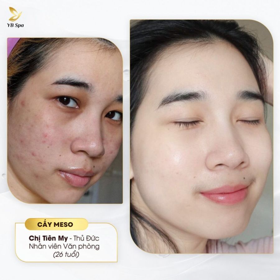 MESO CĂNG BÓNG 25 MESO CĂNG BÓNG