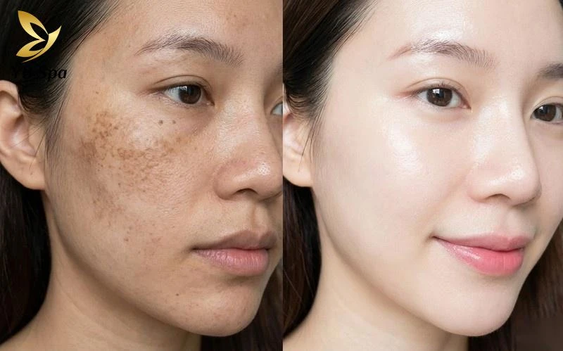 Meso điều trị nám, làm sáng da