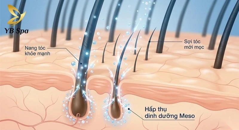 Meso hỗ trợ điều trị rụng tóc
