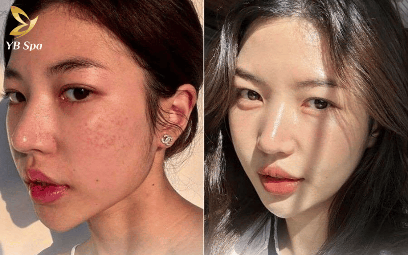 Meso trị thâm mụn là "chìa khóa vàng" giúp xóa tan vết tích sau viêm và trả lại làn da sáng mịn tức thì