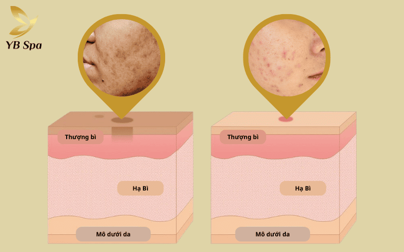 Phân biệt ngay PIH (thâm nâu do sắc tố) và PIE (thâm đỏ do mạch máu) để lựa chọn phương pháp điều trị hiệu quả nhất