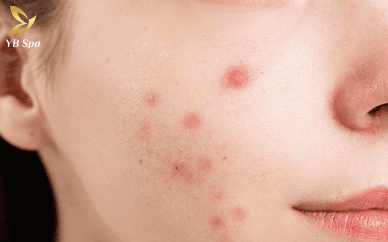 Việc tác động kim trên nền mụn mủ có thể vô tình làm phát tán vi khuẩn P. acnes, khiến tình trạng mụn trở nên tồi tệ hơn