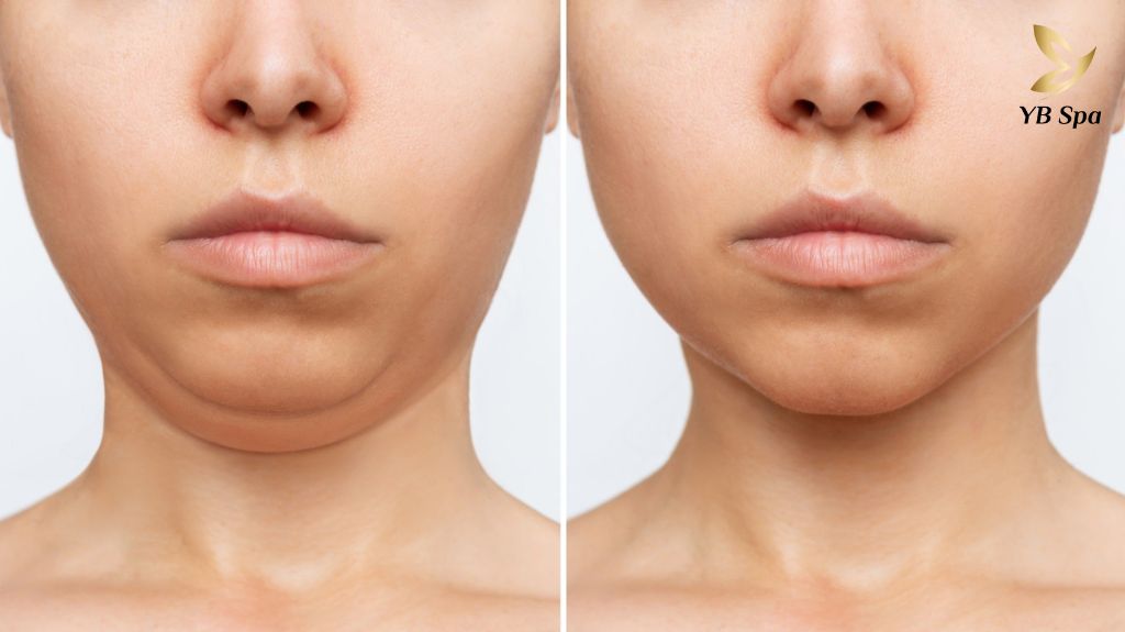 Phân biệt filler và botox: Xu hướng làm đẹp thịnh hành  24 FILLER LÀM ĐẦY