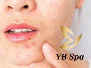 Mọc mụn ở cằm là hiện tượng gì? Nguyên nhân và cách điều trị