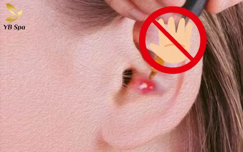 Mọc Mụn Ở Tai Đau Nhức: Nguyên Nhân và Cách Xử Lý 26 Không nặn hoặc gãi mụn Ở Tai