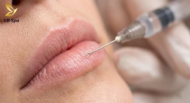 Tiêm filler giúp tạo hình, làm đầy môi, khắc phục dáng môi cá trê hiệu quả.