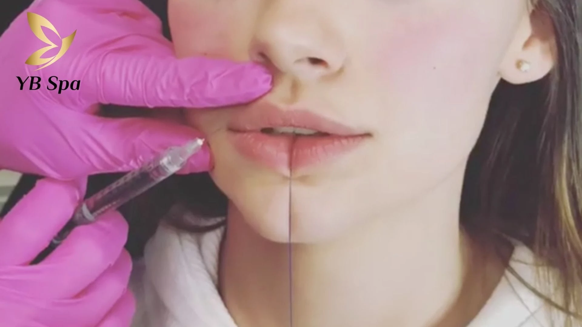 Công nghệ thẩm mỹ giúp tạo môi chẻ rõ nét, duy trì vĩnh viễn hoặc bán vĩnh viễn.