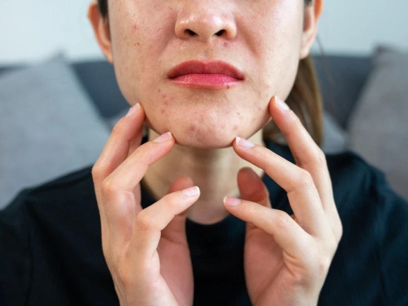 Mụn ẩn có tự hết được không