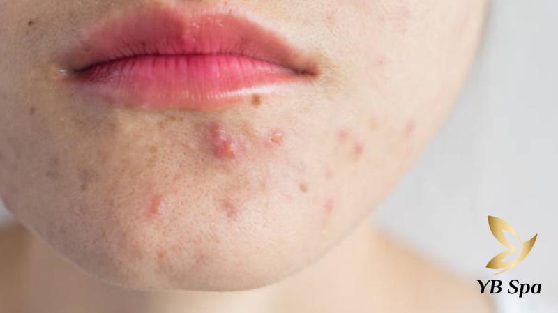 mụn ẩn dưới cằm
