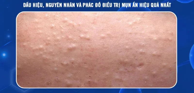 Mụn ẩn là gì? Nguyên nhân & Cách điều trị hiệu quả nhất