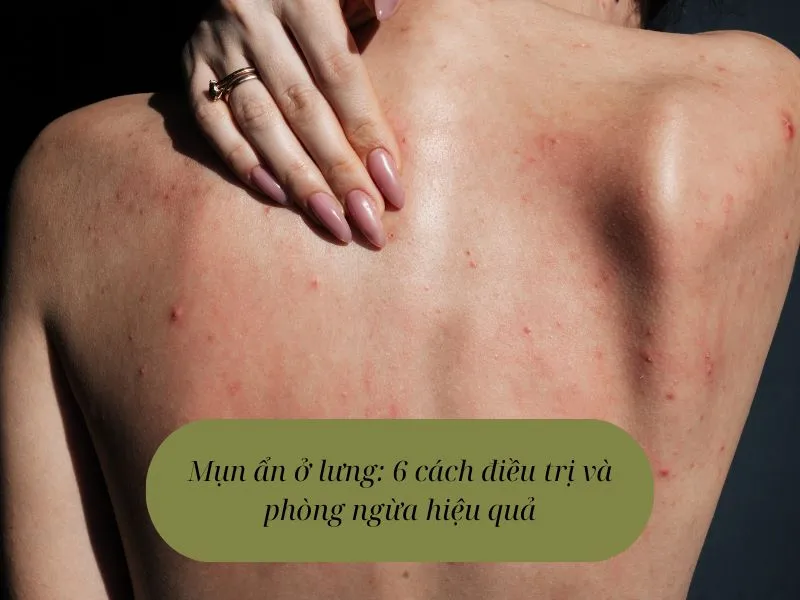 Mụn ẩn ở lưng: 6 cách điều trị và phòng ngừa hiệu quả