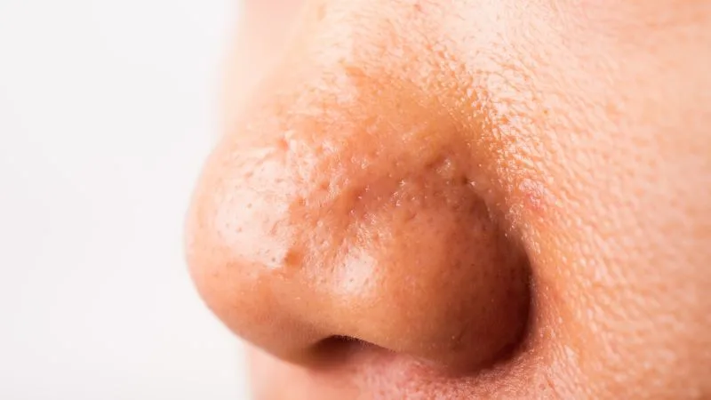 mụn ẩn ở mũi
