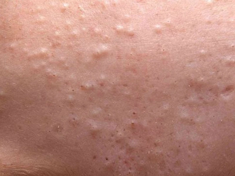 Mụn ẩn trên trán