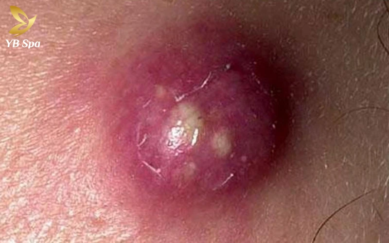 Mụn áp xe có tự khỏi không? Nguyên tắc và biện pháp xử lý an toàn tại nhà 22 Mụn áp xe có tự khỏi không