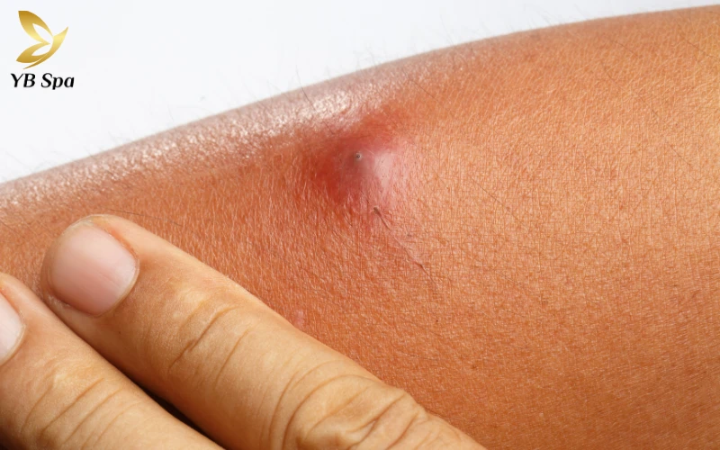 Mụn áp xe có tự khỏi không? Nguyên tắc và biện pháp xử lý an toàn tại nhà 23 Mụn áp xe là gì?