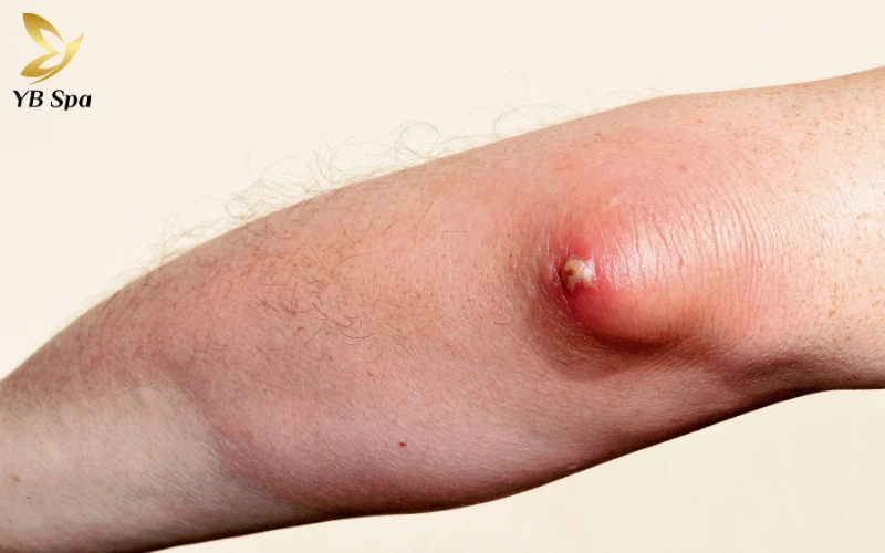 Mụn áp xe có tự khỏi không? Nguyên tắc và biện pháp xử lý an toàn tại nhà 26 Khả năng tự chữa lành của cơ thể