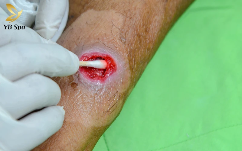 Mụn áp xe có tự khỏi không? Nguyên tắc và biện pháp xử lý an toàn tại nhà 27 Khi nào mụn áp xe trở nên nguy hiểm và cần gặp bác sĩ ngay?