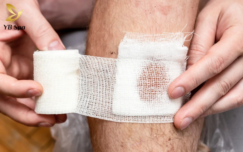 Mụn áp xe có tự khỏi không? Nguyên tắc và biện pháp xử lý an toàn tại nhà 28 Chăm sóc hỗ trợ tại nhà