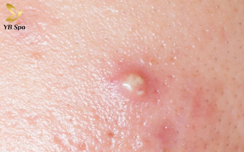 Mụn Bọc Có Tự Xẹp Không