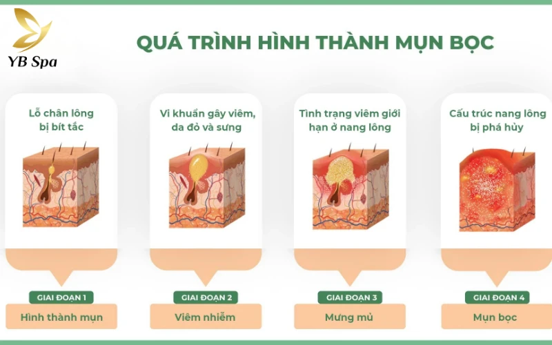 Hiểu Đúng Về Mụn Bọc