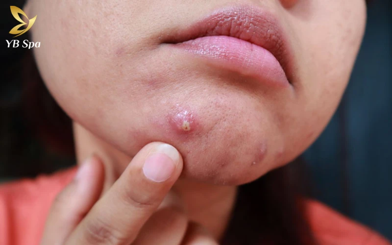 Giai Đoạn Hình Thành Nhân Mủ của Mụn Bọc