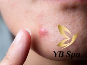 Mụn bọc ở cằm là gì? Nguyên nhân, dấu hiệu và cách điều trị