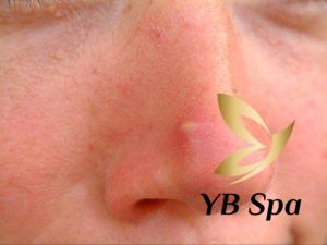 Mụn bọc ở mũi là gì? Nguyên nhân, dấu hiệu và cách điều trị