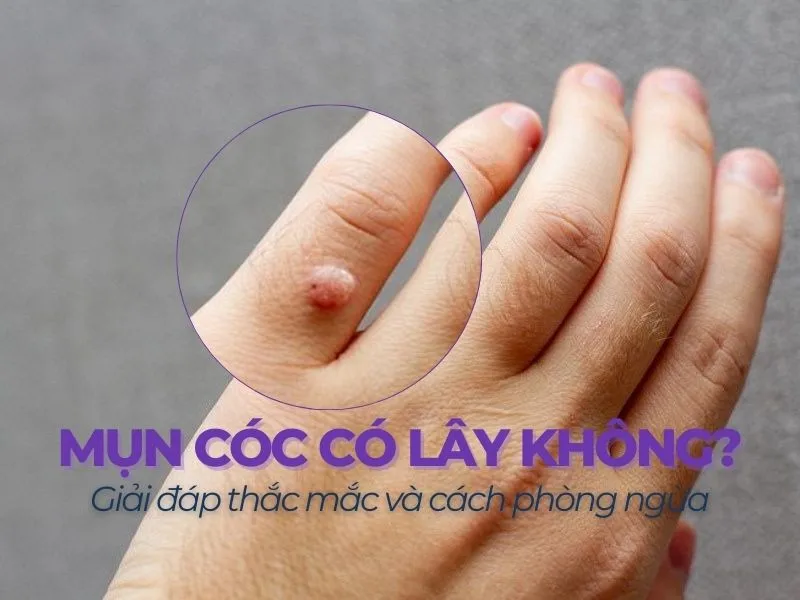mụn cóc có lây không
