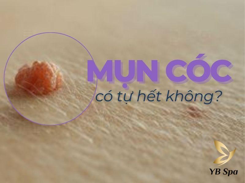 mụn cóc có tự hết không