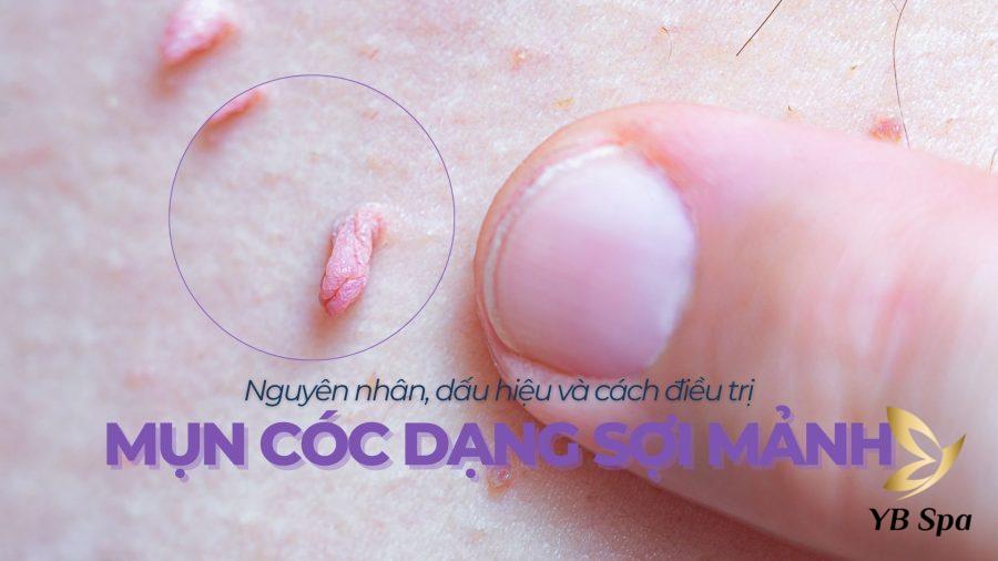 mụn cóc dạng sợi mảnh