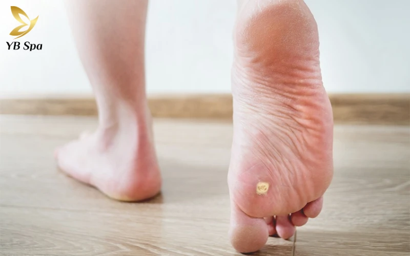 Mụn cóc ở chân