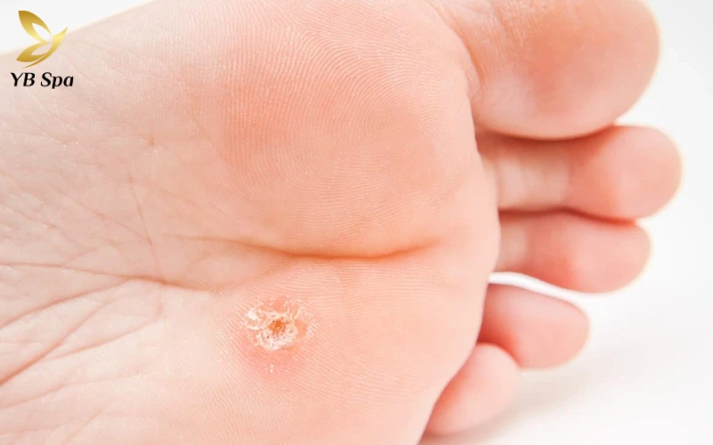 Mụn cóc ở chân có nguy hiểm không? Cách điều trị và ngăn ngừa hiệu quả