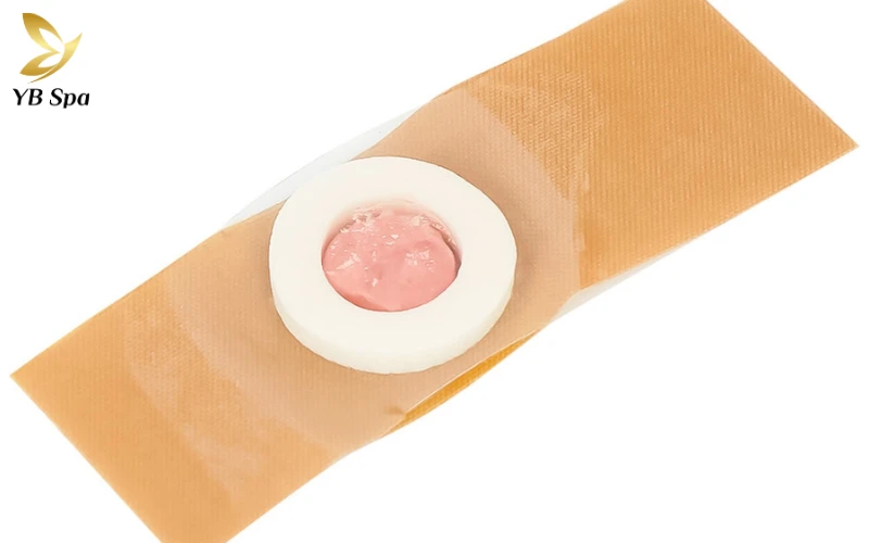 trị mụn cóc ở chân bằng băng dính (Duct Tape Occlusion)