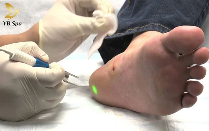 trị mụn cóc ở chân bằng Laser (Pulsed-Dye Laser)