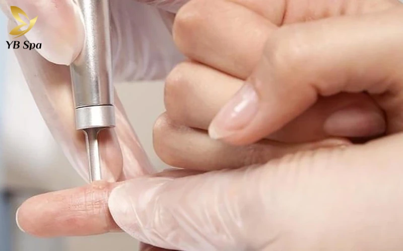 trị mụn cóc ở chân bằng Phẫu thuật cắt bỏ (Excision)