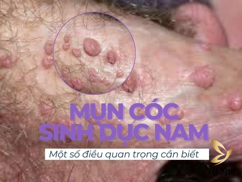 mụn cóc sinh dục nam